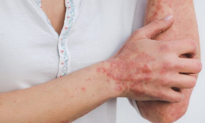Los diferentes tipos de psoriasis: placa, guttato, inversa y más Los diferentes tipos de psoriasis: placa, guttato, inversa y más