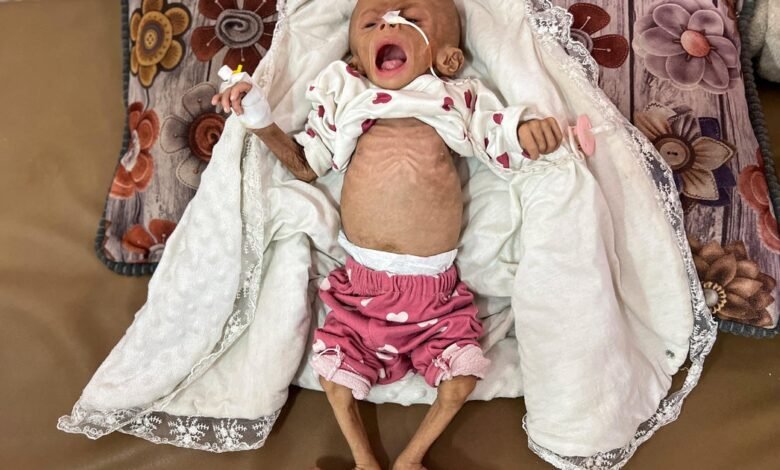 El jefe del Hospital Gaza dijo que 21 niños murieron por la falta de nutrientes en los últimos 3 días.