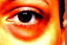 Los jóvenes se están quitando la bolsa de los ojos con cirugía: ¿por qué?