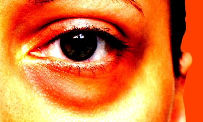 Los jóvenes se están quitando la bolsa de los ojos con cirugía: ¿por qué? Los jóvenes se están quitando la bolsa de los ojos con cirugía: ¿por qué?