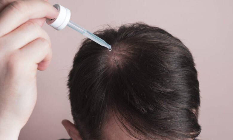 Los implantes para el cabello cuestan en 2025: lo que debe esperar pagar