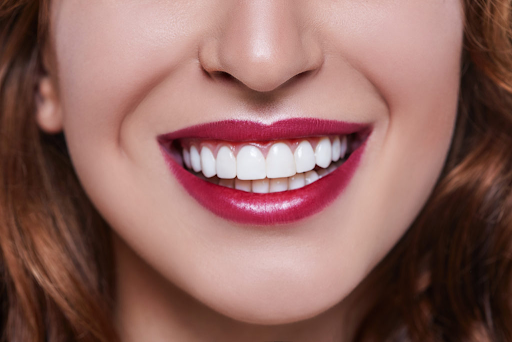 El mejor lugar para carillas en la República Dominicana en el CED Dental Center El mejor lugar para carillas en la República Dominicana en el CED Dental Center