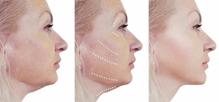¿Es un estiramiento facial en Antalya la elección correcta para usted?