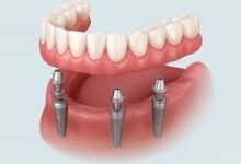 Implantes dentales en la República Dominicana y Costo: sonrisas asequibles en el extranjero