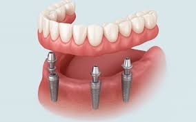 Implantes dentales en la República Dominicana y Costo: sonrisas asequibles en el extranjero