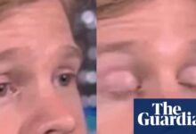 El hombre que se hizo popular en parpadear White Guy GIF recauda más de $ 300,000 para la investigación de esclerosis múltiple | Noticias de EE. UU.