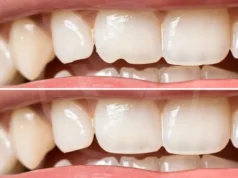 Bonding compuesto en Blackpool: una solución rápida y asequible para una sonrisa hermosa