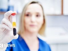 Un análisis de sangre para detectar múltiples cánceres no alcanzó un objetivo clave en un ensayo del NHS