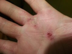 Evmune comienza a presentar argumentos para desafiar el dominio de Dupixent de Sanofi en el tratamiento de la dermatitis atópica