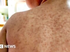 Un brote de sarampión podría provocar la exclusión de los alumnos no vacunados de las escuelas del norte de Londres