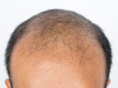 Baldness Biotech Veradermics cuesta 256 millones de dólares en su oferta pública inicial para realizar pruebas fundamentales de una pastilla para la caída del cabello