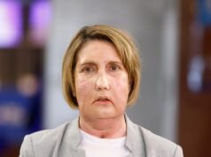 Una mujer con un insecto carnívoro obtiene una nueva CARA de un donante que murió por eutanasia en un impresionante estreno mundial