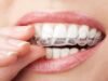 Invisalign Near Me: brackets transparentes para adultos