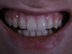 Manchas blancas en los dientes: causas, tratamiento y prevención.