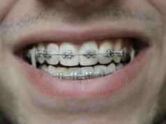 Dientes de plata para niños: ¿por qué los usan los dentistas y son seguros?